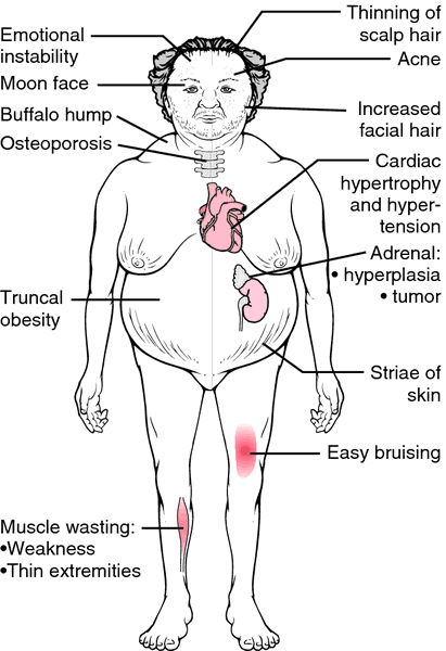 Cushing's syndrome - definition of Cushing's syndrome in the Medical dictionary - by the Free Online Medical Dictionary, Thesaurus and Encyc... Cushing Syndrome, Cushings Disease, Cushing’s Syndrome, Adrenal Cortex, Cushings Syndrome, Medical Dictionary, Endocrine Disorders, Addisons Disease, Autoimmune Disorder