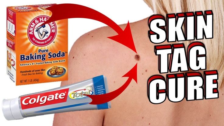 Skin Tags On Face, Disney Savings, Remove Skin Tags, Remove Skin Tags Naturally, Baking Soda Benefits, Tag Remover, Mole Removal, Diy Lotion, Skin Tags