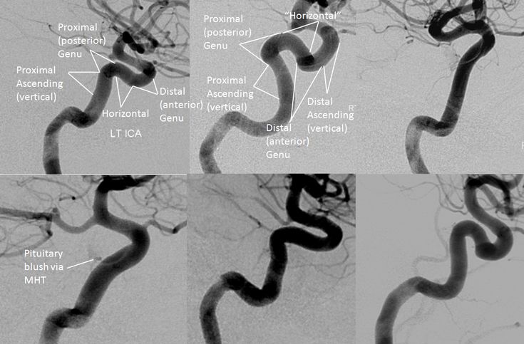 Internal Carotid Artery and Its Aneurysms | neuroangio.org Internal Carotid Artery, Mri Brain, Carotid Artery, Radiology, Headache, Brain, Anatomy, Humor