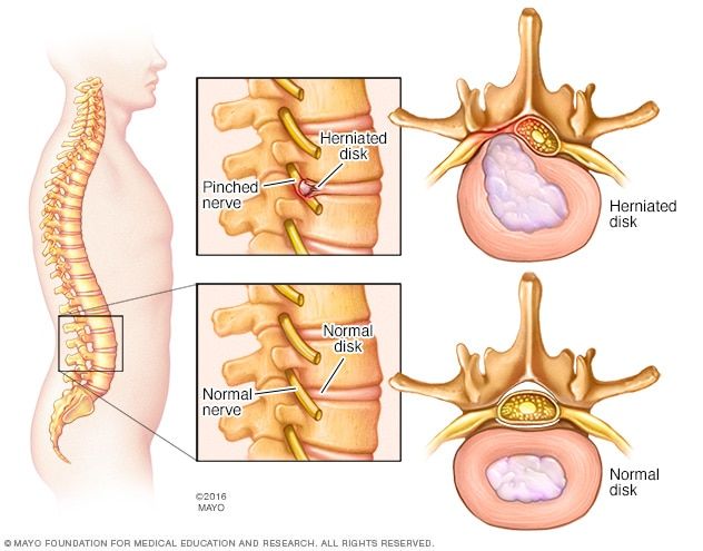 Herniated disk - Symptoms and causes - Mayo Clinic Emt Study, Anaerobic Respiration, Forward Head Posture Exercises, Disc Herniation, Sciatica Symptoms, Lumbar Disc, Chronic Lower Back Pain, Forward Head Posture, Disk Herniation