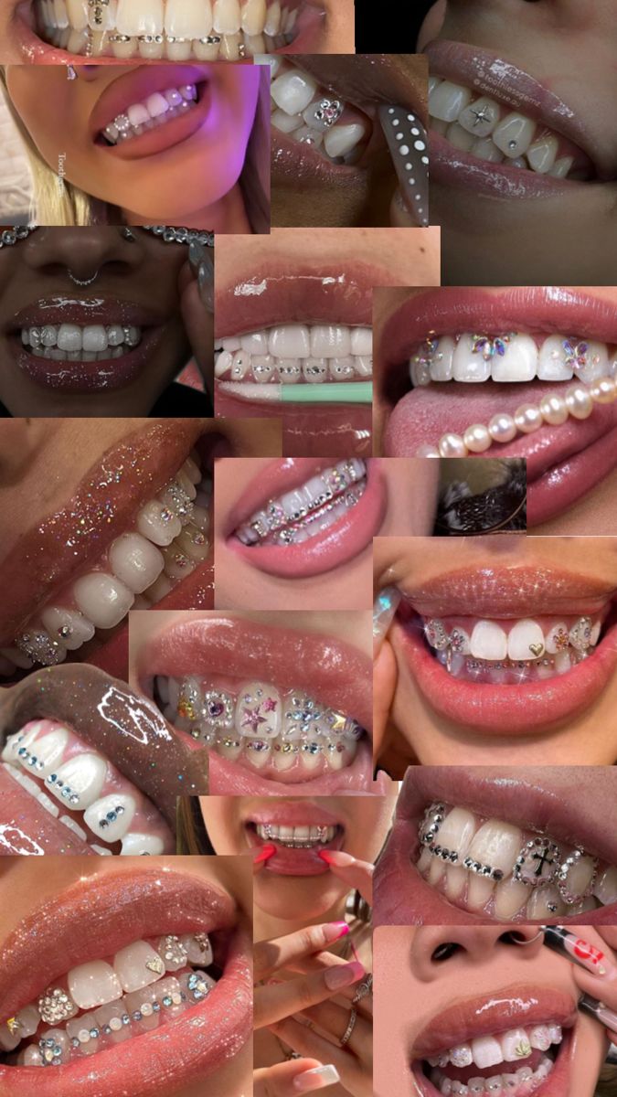 many different pictures of teeth with braces and diamonds on them, all in various positions