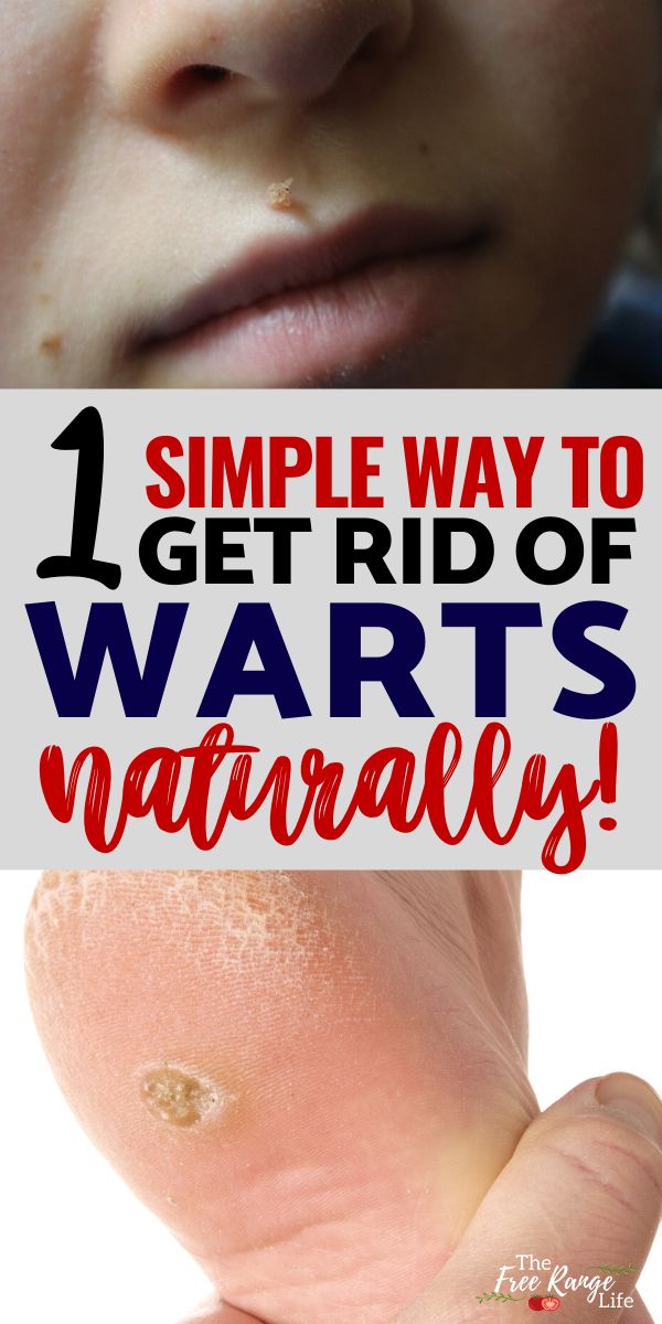 Got a wart on your face, hands or feet? Try this simple trick to get rid of warts fast and naturally! Safe wart removal for kids and safe for use on warts on the face. If you are looking for a safe, effective, natural way to get rid of warts this is it! Planters Wart, Warts On Hands, Warts On Face, Warts Remedy, Get Rid Of Warts, Cold Sores Remedies, Natural Cold Remedies, Natural Cough Remedies, Cold Home Remedies