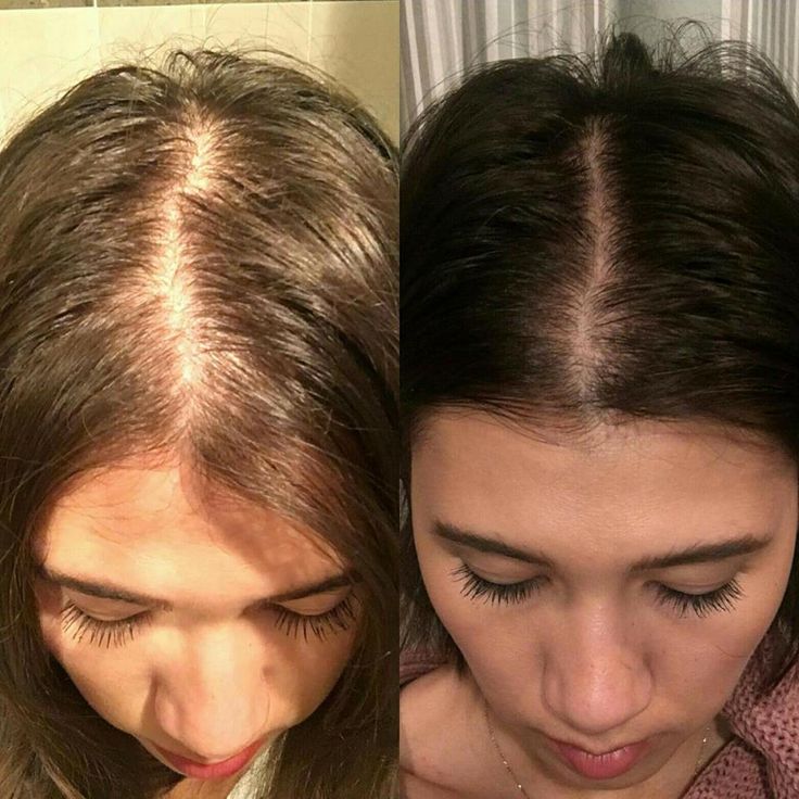 My dear friend Trusted ME. And here we are (with 3 day old hair), a few months into using Monat & not only does her hair appear more thick & fuller but she also has some things to say about it! --"Yes! Like it def doesnt feel stringy like it was before it feels more plump! Im sooo excited!" She did recently chopped off all her, & she's not worried about growth because she knows with Monat, she's not going to have any problem growing it back out Damage Hair, Hair Damage, Hair Fall, Hair Growth, Vitamins, Hair