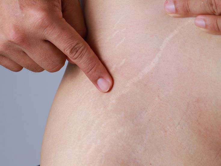 Everything you've ever wanted to know about stretch marks but have been too afraid to ask Stretch Mark Removal Cream, Strech Marks, Stretch Mark Remedies, Stretch Mark Cream, Stretch Mark Removal, Body Hair Removal, Skin Secrets, Skin Essentials, Unwanted Hair Removal