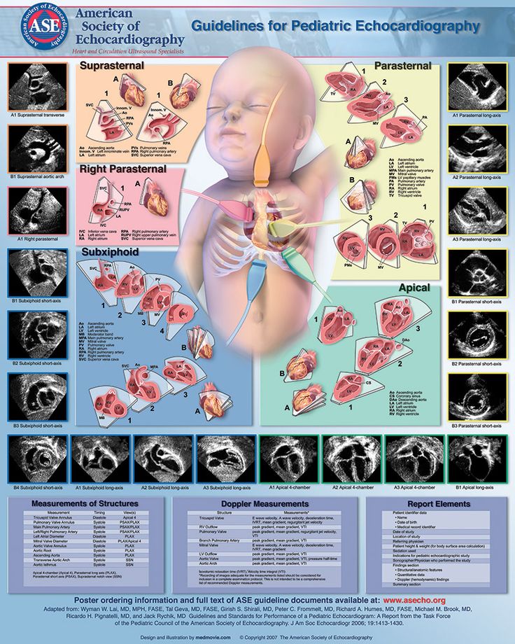 ASE_Poster4_24x30_cmyk Pediatric Echocardiography, Sonogram Technician, Ekg Leads, Cardiac Sonography, Sonography Student, Nursing School Inspiration, Ultrasound Sonography, Pediatric Medicine, Diagnostic Medical Sonography