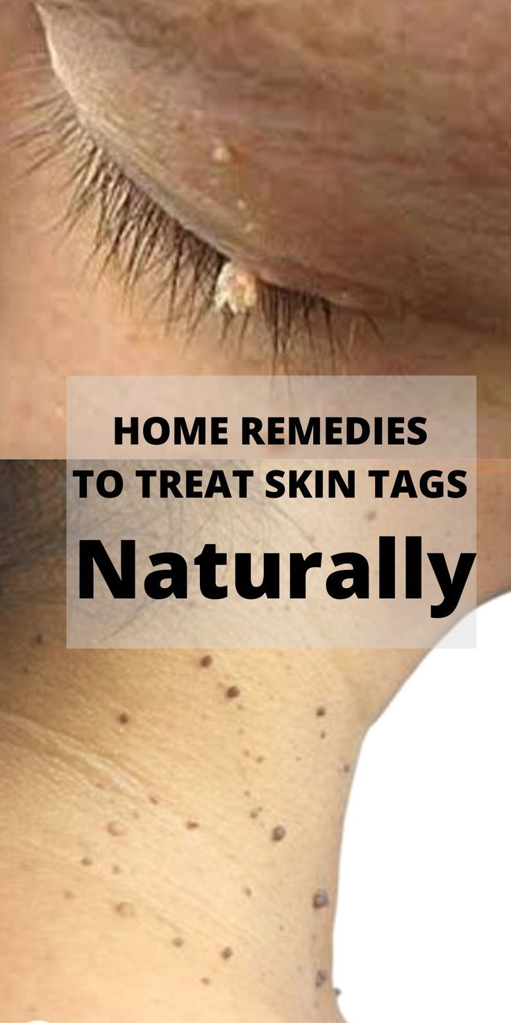 Causes Of Skin Tags, Skin Tags Removal, Remove Skin Tags, Remove Skin Tags Naturally, Fresh Aloe Vera Gel, Natural Mask, Underarm Hair Removal, Get Rid Of Warts, Skin Tags