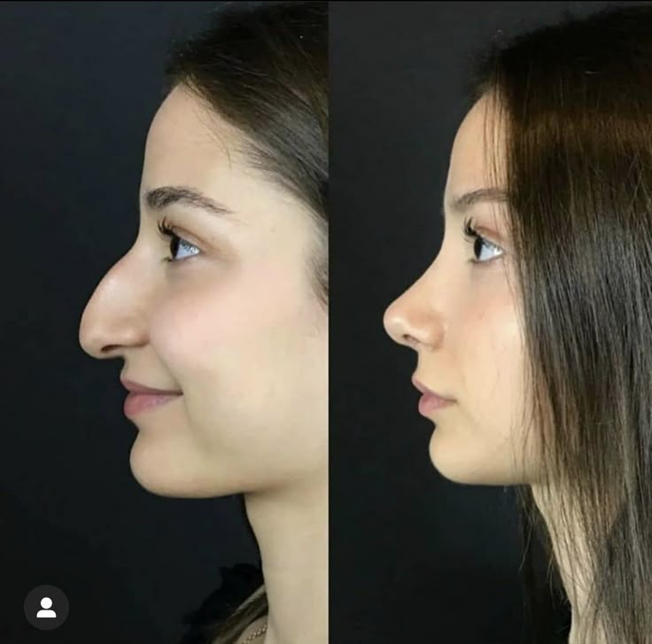 Nose Plastic Surgery, Nose Surgery Rhinoplasty, Plastic Surgery Fail, Rhinoplasty Nose Jobs, Face Surgery, Plastic Surgery Gone Wrong, Rhinoplasty Before And After, Big Nose Beauty, Pretty Nose