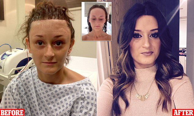 Woman bullied for large forehead got £6,500 surgery to make it smaller Forehead Lowering Surgery, High Forehead Bangs, Hairstyles High Forehead, Haircut For Large Forehead For Women, Hairstyles For Large Foreheads For Women, How To Hide Big Forehead, Bangs For High Forehead, Large Forehead Hairstyles For Women, How To Make Your Forehead Smaller