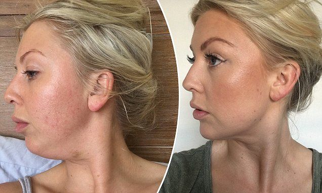 How one woman finally got rid of her double chin WITHOUT liposuction Chin Reduction, Lipo Before And After, Moisture Face, Undereye Bags, Reduce Double Chin, Double Menton, Jaw Surgery, Aging Backwards, Neckline Slimmer