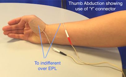 Tens Unit Placement, Tens Therapy, Physiotherapy Student, Queen Margaret, Tens Unit, Health Device, Ten Unit, Cupping Therapy, Muscle Weakness