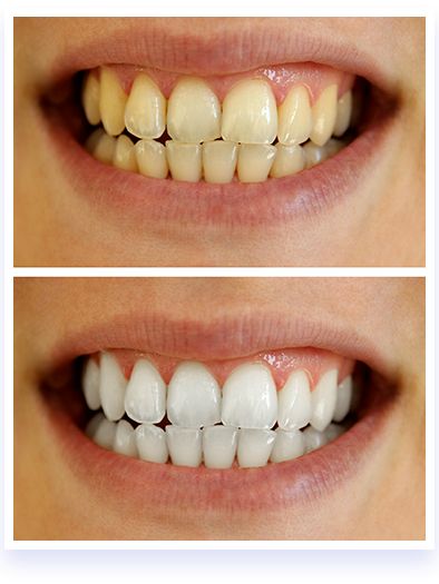 Have White Teeth Red Wine Stains, Teeth Bleaching, Teeth Whitening System, Yellow Teeth, Tooth Enamel, Wine Stains, Red Led Lights, Natural Teeth Whitening, White Smile