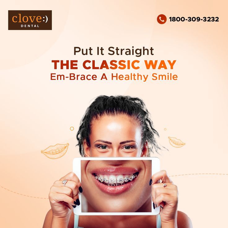 Braces are the classiest way to align crooked teeth. Visit only a professional orthodontist to get misaligned teeth treated, you can choose from various new-age braces to compliment your smile. Make an appointment at Clove Dental today! 😃 Clove Dental, Dental Puns, Dental Advertising, Misaligned Teeth, Dental Posts, Beauty Skin Quotes, Crooked Teeth, Dental Marketing, Dental Braces