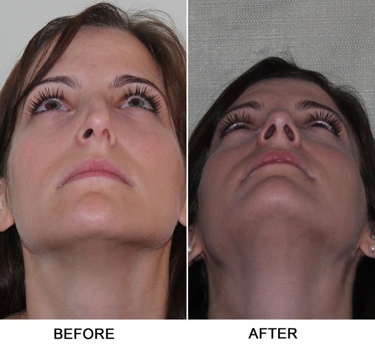 Vestibular Stenosis, Turbinate Reduction, Septoplasty Nose Lift Without Surgery, Lower Blephoraplasty Surgery, Lipo Before And After, Tubal Reversal Surgery, Face Procedures, Rhinoplasty Swelling Progression, Thyroglossal Duct Surgery, Nose Surgery, Yahoo Search