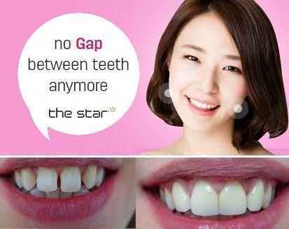 Teeth Gap, Gap Teeth, Front Teeth, The Teeth, The Shape, The Process, Laminate, Gap, Beauty