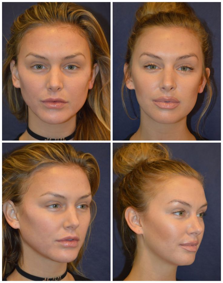 Lala Kent, before and after her treatments with Dr. Diamond. Botox Brow Lift, Cheek Implants, Lala Kent, Chin Implant, Botox Before And After, Face Fillers, Botox Lips, Aesthetic Dermatology, Eyebrow Lift