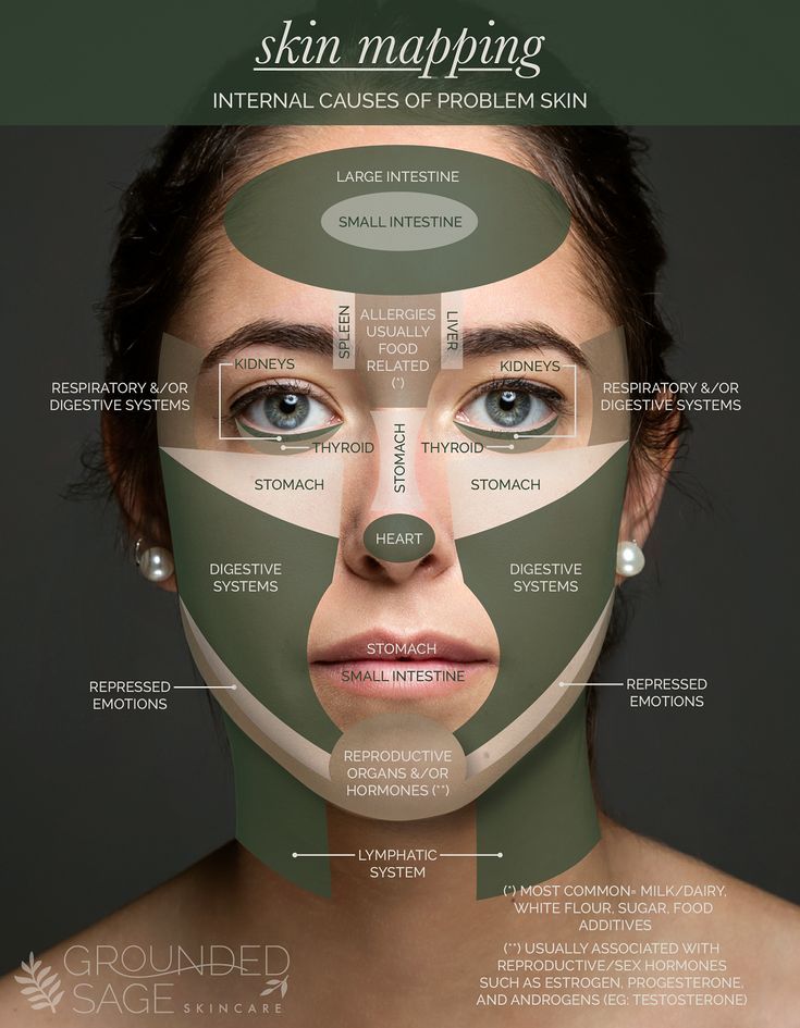 Acne Zones Face Mapping, What Breakouts Mean Face Mapping, Location Of Pimples Meaning, Spot Face Map, Pimple On Face Reason, Why Do I Get Pimples On My Chin, Why Is My Forehead Breaking Out, Spot Mapping Face, Breaking Out On Cheeks