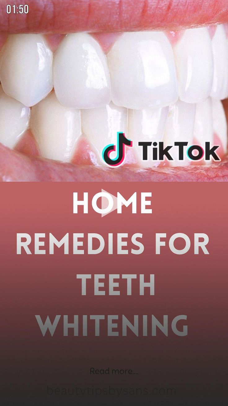 Toddler Tooth Decay, Teeth Whitening Methods, Tooth Ache Relief, Coconut Oil For Teeth, Teeth Whitening Diy, Coconut Oil Pulling, Gum Care, Natural Teeth Whitening, Holistic Remedies