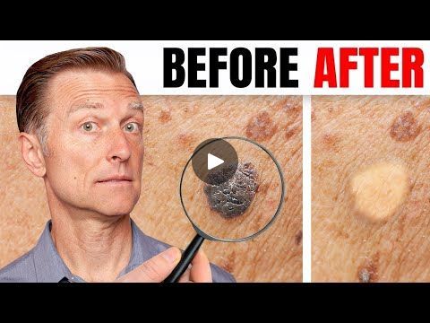 How to Remove Skin Tags and Warts Overnight - Dr. Berg Explains - Dr. Eric Berg DC | How to Remove Skin Tags and Warts Overnight - Dr. Berg Explains - Dr. Eric Berg DC | By Dr. Eric Berg DCFacebook Skin Tags What Causes, Skin Tags On Face, Remove Moles, Remove Skin Tags, Eric Berg, Mole Removal, Get Rid Of Warts, Dr Berg, Doctor Advice