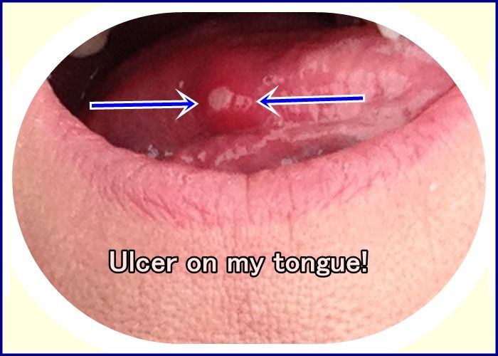 Home Remedies for Mouth Ulcers Sore Tongue Remedy, Tongue Ulcer Remedies, Sore On Tongue Remedy, Mouth Blister Remedy, Ulcers In Mouth, Mouth Ulcer Remedies, Sore In Mouth Remedies, Canker Sore On Tongue, Throat Ulcers