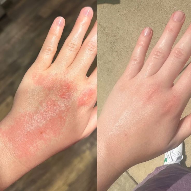 Today starts National Eczema Week so I thought I’d shine a little spotlight on this overnight transformation! I have battled with eczema since I was a baby & the relief is not always this speedy… There have been many times where I cannot open my hands fully, or my skin cracks open when I hold a pen, & constantly being asked “did you get in a fight?” because of the inflammation & sores on my knuckles. I went YEARS before discovering my skin wasn’t ‘just dry’ and that I didn’t need another cre... Road Rash, Burn Mark, Open When, Dermatology, My Skin, Vision Board, Pen, Road, Collage