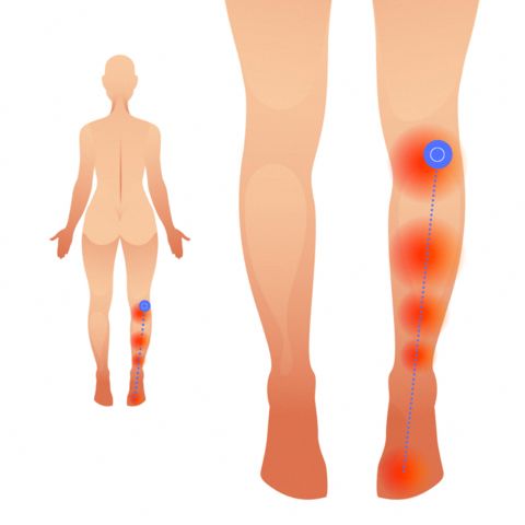 Trigger points in Plantaris are often associated with &quot;unexplained&quot; pain at the back of the knee  Trigger Points and Knee Pain - Overview     Any therapist Soleus Muscle, Gastrocnemius Muscle, Trigger Point Release, Pressure Point Therapy, Calf Pain, Inner Knee Pain, My Knee Hurts, Calf Cramps, Swollen Knee