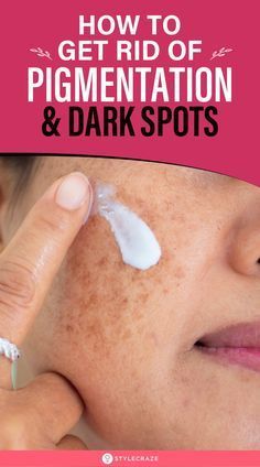 Pigmentation Remedy, Dark Spots Remedies, Brown Spots On Skin, Home Remedies For Skin, Dark Spots On Face, Skin Pigmentation, Brown Spots Removal, Brown Spots On Face, Dark Spots On Skin