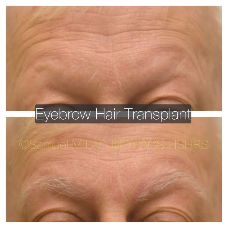 Eyebrow Loss, Eyebrow Hair Transplant, Eyebrow Transplant, Hair Growth Cycle, Eyebrow Trimmer, Laser Tattoo, Laser Tattoo Removal, Natural Eyebrows, Perfect Eyebrows