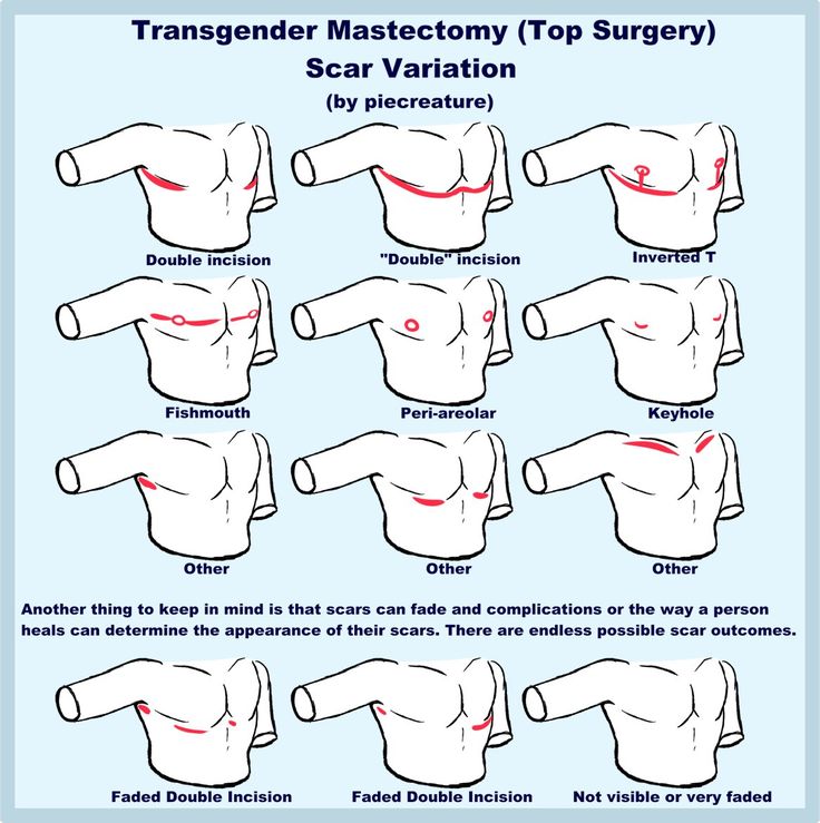 the instructions for how to wear a top surgery procedure in order to prevent back pain