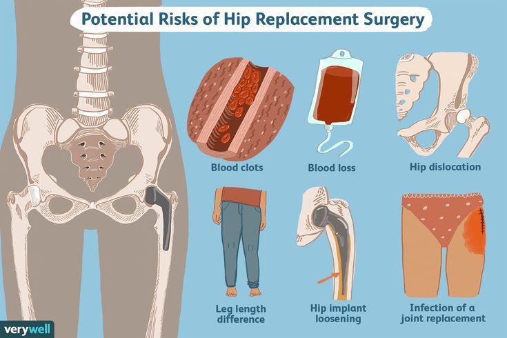 Hip Replacement Surgery: Things to Consider Hip Operation, Hip Surgery Recovery, Hip Implants, Hip Dislocation, Physical Therapy Student, Hip Surgery, Lower Back Pain Exercises, Surgery Recovery, Baby Legs