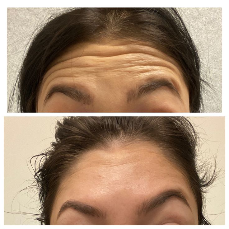 Rf Before And After Pictures, Botox Before After, Lash Photography, Botox Facial, Eye Lash Photography, Botox Before And After, Botox Lips, Homemade Face Mask, Botox Face