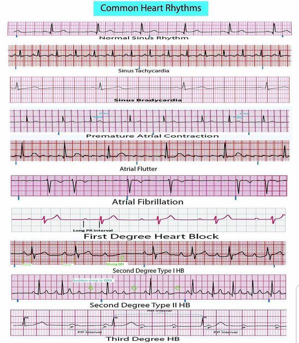 A comprehensive field reference for 12 lead EKG interpretation Field Reference, Ekg Rhythms, Cardiothoracic Surgeon, Fitness Assessment, Cardiology Nursing, Ekg Interpretation, Ecg Interpretation, Cardiac Rhythms, Cardiac Nurse