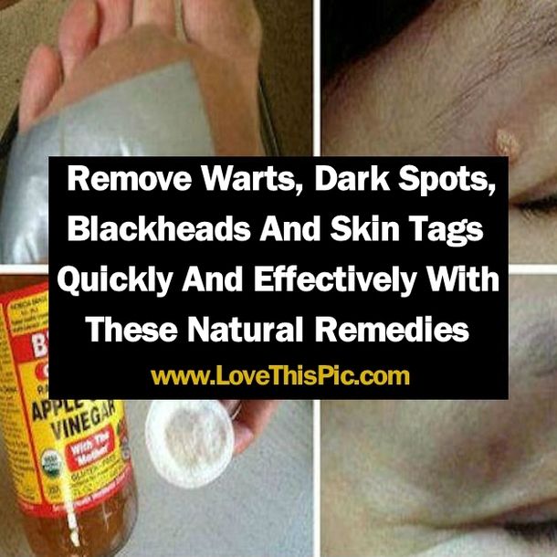 From time to time we all get affected by many skin disorders such as warts, moles. skin tags or dark spots. Fortunately, there are ways to get rid of them that are completely harmless, healthy and natural. Apple Cider Vinegar For Skin, Remove Warts, Korean Beauty Secrets, Skin Tags, Home Remedies For Hair, Beauty Diy, Beauty Remedies, Acne Remedies, Skin Remedies