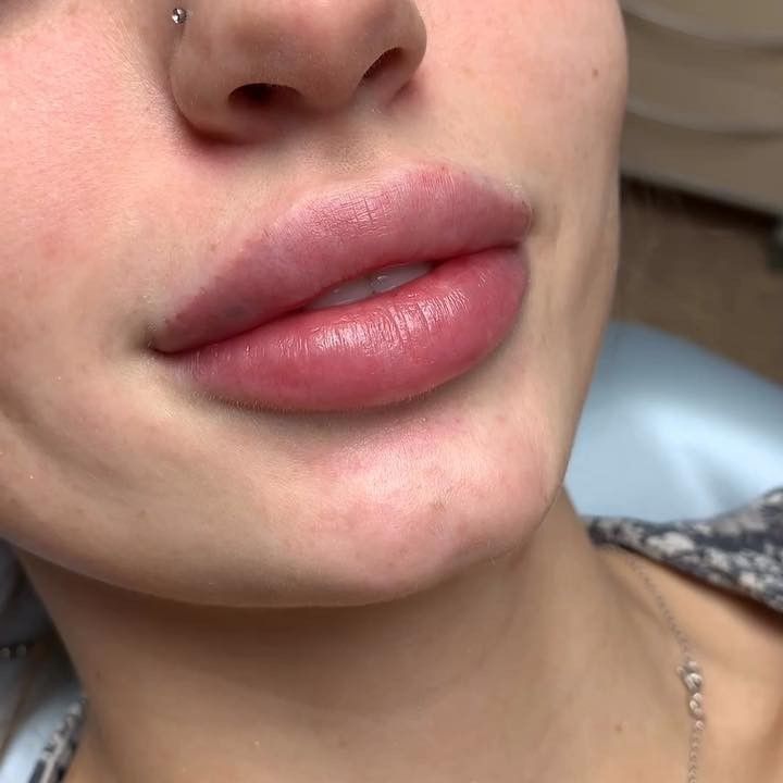 Lip Injections Aesthetic, Lip Plumpers That Work, Lip Fillers Juvederm, 1ml Lip Filler, Makeup Gift Ideas, Aesthetic Lip Gloss, Lip Gloss Aesthetic, Russian Lips, Lip Routine