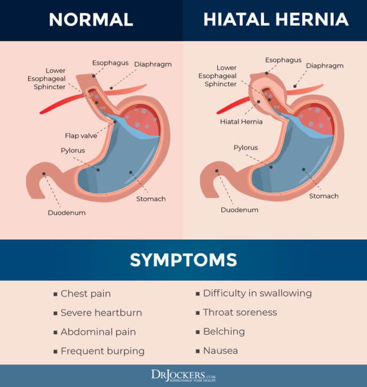 Arriba 101+ Foto Como Se Ve Una Hernia Hiatal Actualizar