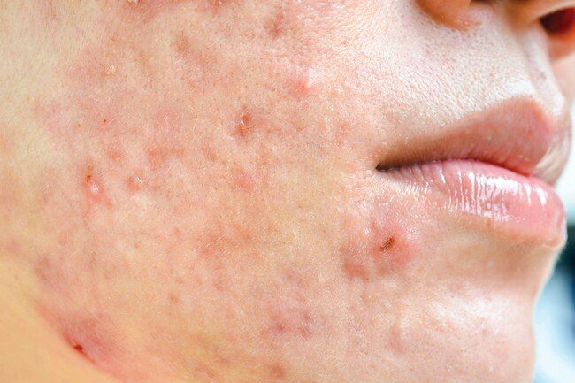 Skin Problems Linked to IBD Cystic Acne On Chin, Acne Causing Foods, Acne Diet, Natural Acne Remedies, Natural Acne, Acne Oil, Acne Causes, Acne Problem, Hormonal Acne