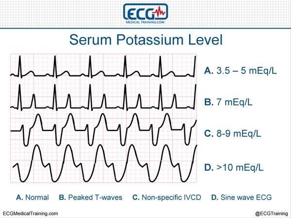 allheartcare: “ “ How elevated serum potassium levels affect the ECG (it is not always this linear) ” ” Pass Nursing School, Atrial Septal Defect, Student Info, Nursing Student Tips, Cardiac Nursing, Nursing School Survival, Critical Care Nursing, Nursing School Studying, Nursing School Notes