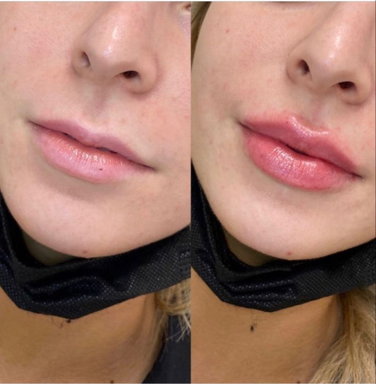 Simple Lip Injections, Natural Looking Filled Lips, Lip Filler Contour, Lip Filler M Shaped Lips, Small Lip Injections Before And After, Lip Injections Small Lips, Lip Filler Before And After Side Profile, Face Symmetry Fillers, Pouty Lips Injections