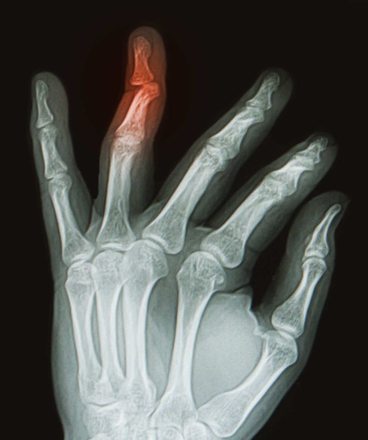 an x - ray image of a hand with the wrist and thumb highlighted in red