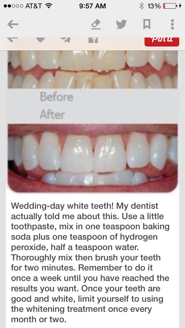 Whiten Teeth With Baking Soda, Baking Soda Teeth, Baking Soda Teeth Whitening, Teeth Whitening Homemade, Teeth Whitening Remedies, Teeth Whitening Diy, Charcoal Teeth Whitening, Pasta Dental, Whiten Teeth