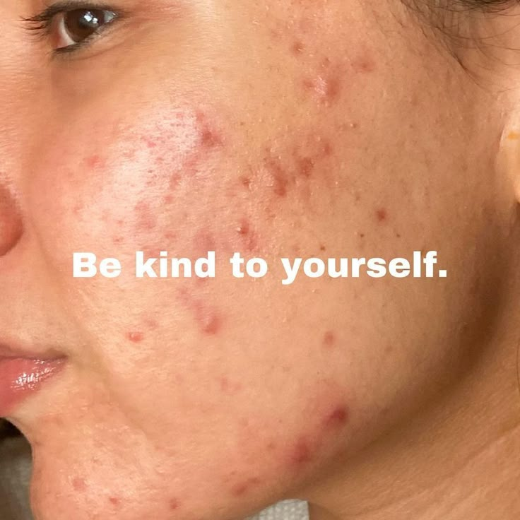 Note to self ❤️⁠ Face Mapping Acne, Blind Pimple, Forehead Acne, Pimples Overnight, How To Get Rid Of Pimples, Skin Condition, Clearer Skin, Love Your Skin, Pretty Skin