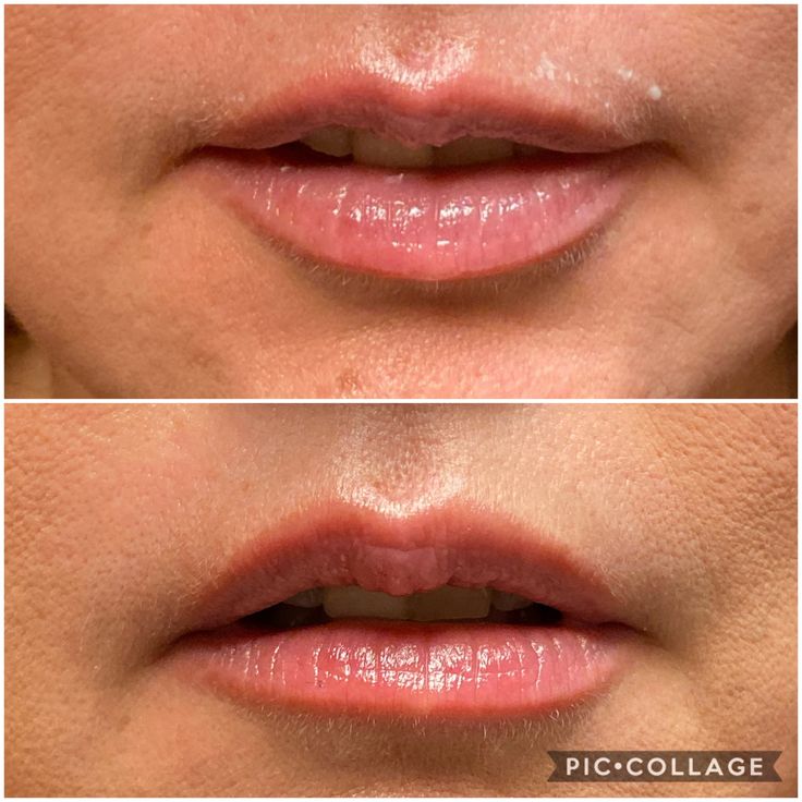 Our BOTOX LIP FLIP is perfect for beautiful Holiday Lips!This Starts as low as 50$. A delicate placement of Botox elevates the lip edge and gives the illusion of fuller sharper lips💋 Call 719-544-4405 only 3 limited bookings still available for Christmas. #botoxlipflip #lippop #botoxpro Lips With Filler, Botox Aesthetic, Botox Lip Flip, Dermal Fillers Lips, Pouting Lips, Botox Wrinkles, Lip Flip, Plumper Lips, Lip Lift