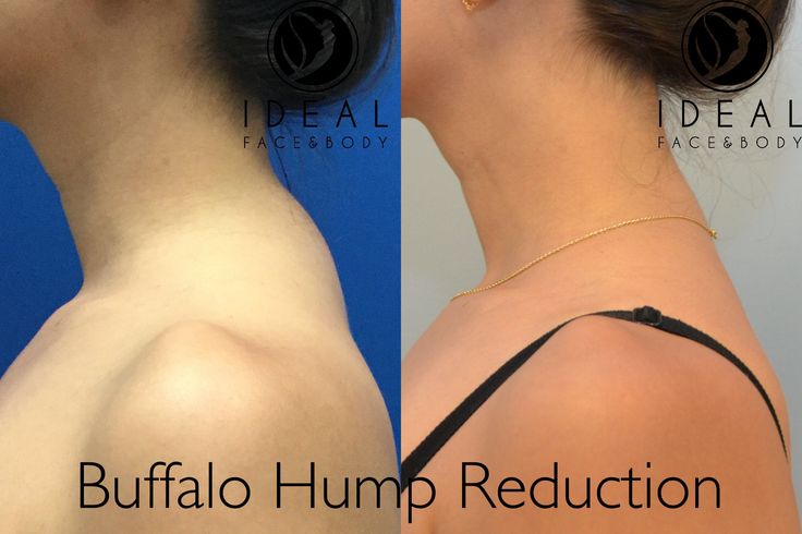 Buffalo Humps are more common than most people think. This patient is shown before & 4 months after liposculpting. Just like stubborn love handles, it's an area where fat can accumulate and is unresponsive to diet and exercise. The good thing is that there is an answer: Precision Body Sculpting. Dr. Yovino has a specialized Liposculpting technique performed in the office under local anesthesia with 1-2 days of easy recovery. 310.887.9999 Stubborn Love, Dowager's Hump, Lipo Before And After, Local Anesthesia, Neck Hump, Neck Exercises, Health Podcast, Diet And Exercise, Love Handles