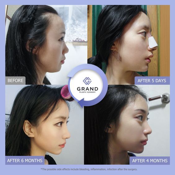 Jaw Reduction Surgery, Nose Plastic Surgery, Nose Surgery Rhinoplasty, V Line Surgery, Plastic Surgery Fail, Korean Plastic Surgery, Rhinoplasty Nose Jobs, Plastic Surgery Gone Wrong, Face Surgery