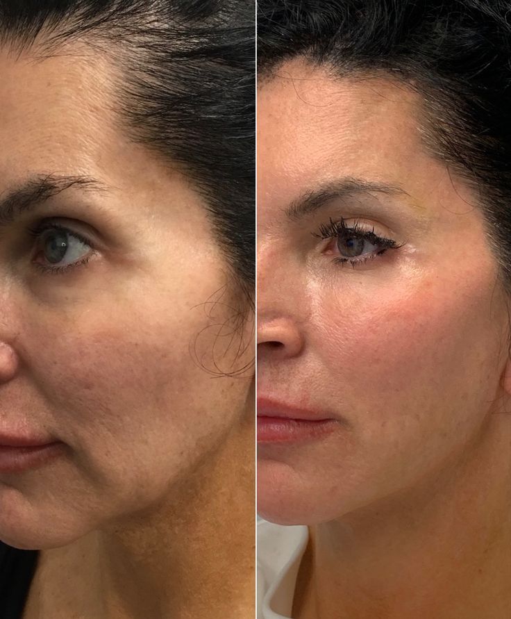 Our lovely patient looks more young  and rested after volume restoration & lower face lift with threads. Way to get natural results nonsurgically Lower Face Lift, Thread Lift Face, Face Plastic Surgery, Derma Facial, Face Threading, Facial Procedure, Cheek Lift, Face Fillers, Face Surgery