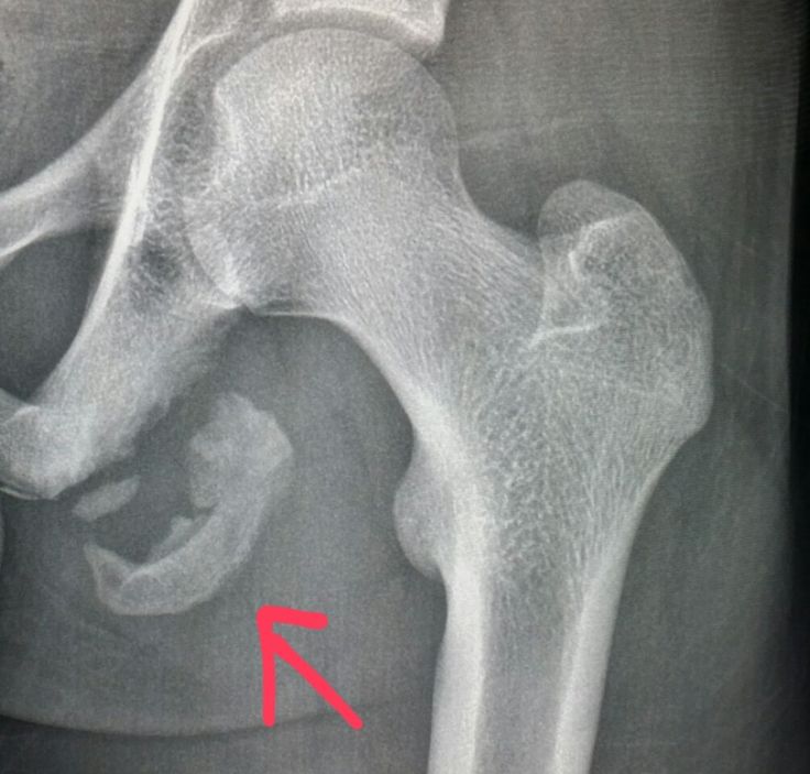 #Hip #xray shows a #fracture (#avulsion) of #bone from #tear of the #hamstring #tendon in a #patient with #pain from #sports #injury. #radiologist #radiology #trauma Hip Xray, Torn Hamstring, Radiologic Technology, Nuclear Medicine, Xray Tech, Lower Limb, Rad Tech, Sports Injury, Work Memes