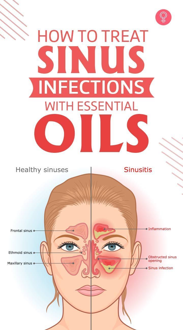 Essential Oil For Sinus Pressure, How To Get Rid Of A Sinus Infection, Essential Oils For Sinus Relief, How To Get Rid Of Sinus Pressure, Diy Sinus Pressure Relief, Remedy For Sinus Infection, Essential Oils For Sinus Infection, Sinus Infection Relief Essential Oils, Get Rid Of Sinus Infection Fast