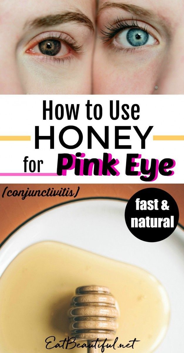 Honey is the fastest and most effective remedy I've used for pinkeye. This post shares with you how to use it, why it works and some other natural approaches. | Eat Beautiful || #pinkeye #honey #DIY #remedy Treating Pink Eye, Pink Eye Home Remedies, Natural Pink Eye Remedy, Honey Health Benefits, Pinkeye Remedies, Eat Beautiful, Holistic Health Remedies, Pink Eye, Natural Cough Remedies