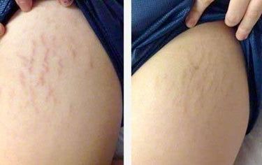 Unlock Stretch Mark Skincare Secrets! 🥰️ stretch mark underarm, stretch marks lotions, what to use for stretch mark #healthyskin #wellness #skincare Marks Cream, Pregnancy Weight Gain, Skin Marks, Skincare Secrets, Best Lotion, Face Care Routine, Stretch Mark Cream, Stretch Mark, Skin Care Remedies