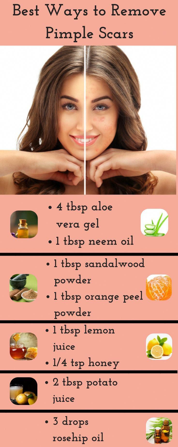 Doterra Acne, Pimple Scar Removal, Pimple Scars, Natural Hair Mask, How To Get Rid Of Pimples, How To Remove Pimples, Beauty Tips For Face, Scar Removal, Acne Remedies