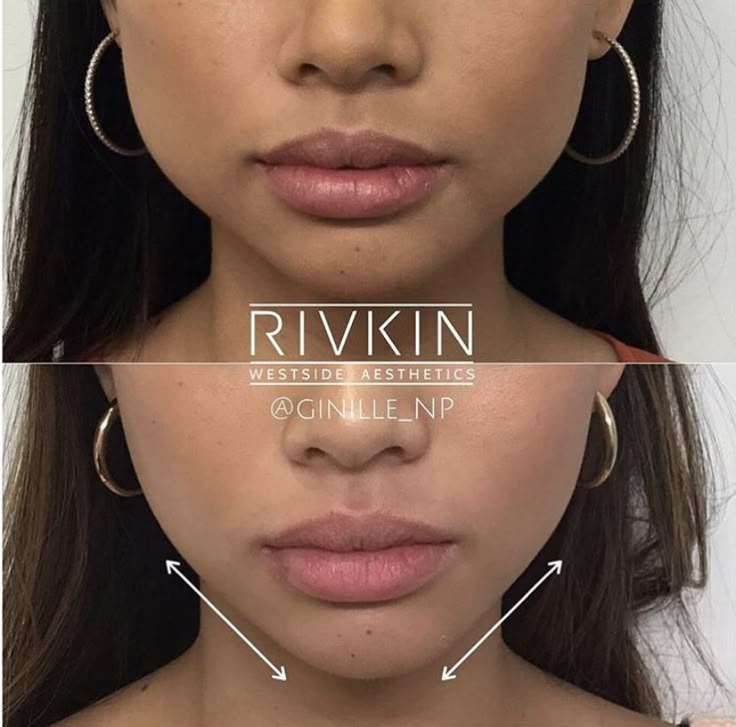 Face Injections, Face Plastic Surgery, Botox Facial, Rhinoplasty Nose Jobs, Botox Before And After, Face Fillers, Face Surgery, Homemade Face Mask, Botox Face